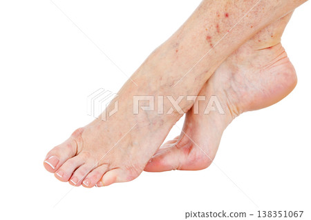 Female feet with vascular stars on the skin, isolated Female feet with vascular stars on the skin, isolated 138351067