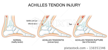 Achilles tendon injury. Healthy anatomy and the progression from tendinitis to rupture Achilles tendon injury. Healthy anatomy and the progression from tendinitis to rupture 138351346