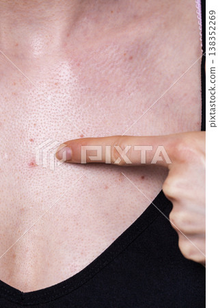 Woman having pimples red spots on chest 138352269