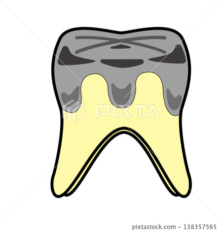 Illustration of a molar with a silver filling and decay / Dentistry and dental care Illustration of a molar with a silver filling and decay / Dentistry and dental care 138357565
