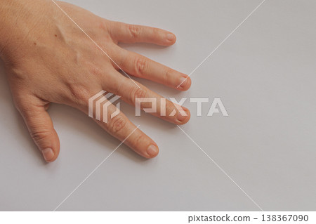Female hand with fingers spread showing bitten nails and dry cuticles on a white background. Realistic shot of unkempt fingernails with large copy space on the right Female hand with fingers spread showing bitten nails and dry cuticles on a white background. Realistic shot of unkempt fingernails with large copy space on the right 138367090