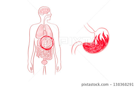 Gastroesophageal reflux pain 138368291