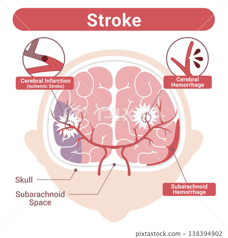 Illustration comparing different types of stroke (cerebral infarction, cerebral hemorrhage, subarachnoid hemorrhage) - English version 138394902