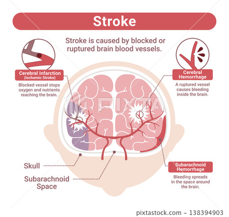 Illustration comparing different types of stroke (cerebral infarction, cerebral hemorrhage, subarachnoid hemorrhage) - English version 138394903