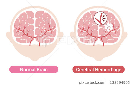 Comparison of a brain with a brain hemorrhage and a normal brain: Medical illustration (English version) 138394905