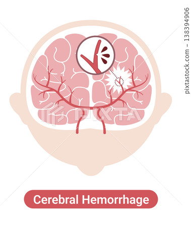 Cerebral hemorrhage: Medical illustrations (English version) 138394906