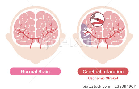 Comparison of a stroke-affected brain and a normal brain: Medical illustration (English version) Comparison of a stroke-affected brain and a normal brain: Medical illustration (English version) 138394907