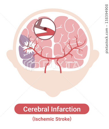 Stroke: Medical Illustrations (English Version) Stroke: Medical Illustrations (English Version) 138394908