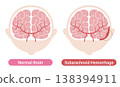 Comparison of a subarachnoid hemorrhage and a normal brain: Medical illustration (English version) 138394911