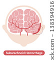 Subarachnoid hemorrhage: Medical illustration (English version) 138394916