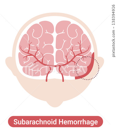 Subarachnoid hemorrhage: Medical illustration (English version) Subarachnoid hemorrhage: Medical illustration (English version) 138394916