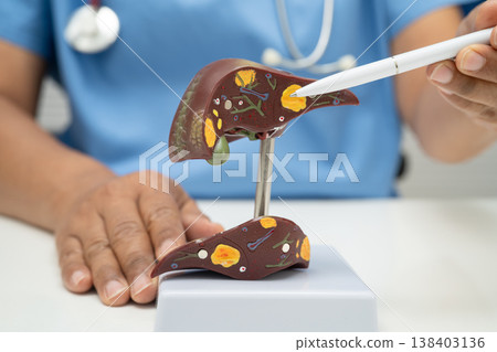 Cirrhosis, Liver cancer, fatty liver, Asian doctor with liver human anatomy model in World Hepatitis Day at hospital. Cirrhosis, Liver cancer, fatty liver, Asian doctor with liver human anatomy model in World Hepatitis Day at hospital. 138403136