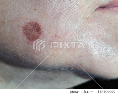 A close view of a cheek showing a pigment spot two days after undergoing laser treatment. The skin has slight changes in color and texture around the spot, indicating the treatment effects. A close view of a cheek showing a pigment spot two days after undergoing laser treatment. The skin has slight changes in color and texture around the spot, indicating the treatment effects. 138409099