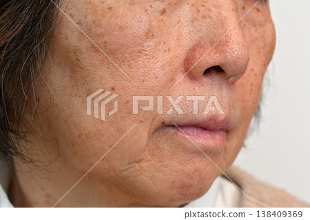 受臉部瑕疵、皺紋、雀斑、痣和疣困擾的老年女性 受臉部瑕疵、皺紋、雀斑、痣和疣困擾的老年女性 138409369