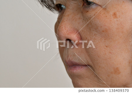Senior women who are troubled by facial spots, wrinkles, freckles, moles, and warts 138409370