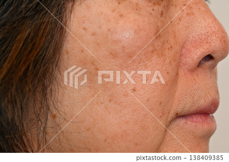 Senior women who are troubled by facial spots, wrinkles, freckles, moles, and warts 138409385