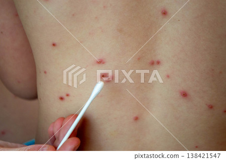 Natural vaccination. Contagious disease. Sick child with chickenpox. Varicella virus or Chickenpox bubble rash on child body and face. High quality photo 138421547