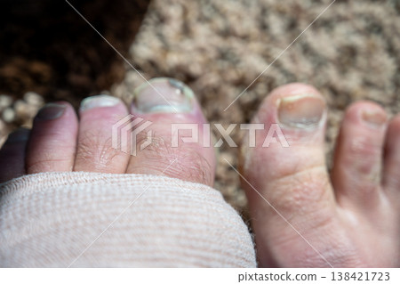 Injury on a foot with bandaging and bruising shows toes with clear nails on a rough surface Injury on a foot with bandaging and bruising shows toes with clear nails on a rough surface 138421723