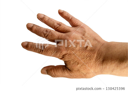 The texture and wrinkles of hands due to aging 138425396