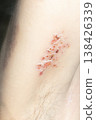 Woman with shingles on the skin she feels very painful 138426339