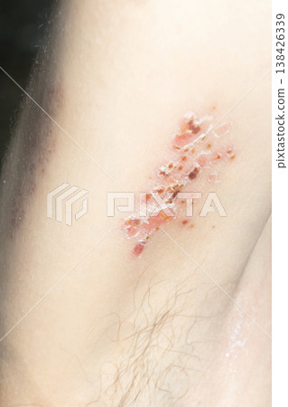 Woman with shingles on the skin she feels very painful 138426339