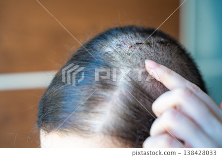 Surgical scar on scalp with hair regrowth after operation. Healing process and recovery after medical procedure concept. Surgical scar on scalp with hair regrowth after operation. Healing process and recovery after medical procedure concept. 138428033