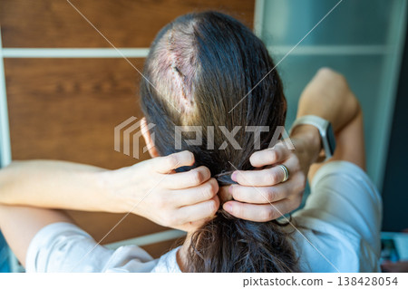 Woman with partially shaved head tying hair in ponytail revealing surgical scar after brain tumor removal. Oncology recovery and body acceptance concept. Woman with partially shaved head tying hair in ponytail revealing surgical scar after brain tumor removal. Oncology recovery and body acceptance concept. 138428054