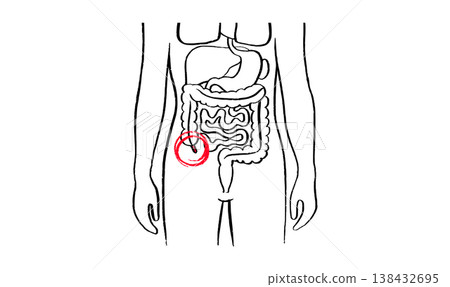 Inflamed appendix scetch Inflamed appendix scetch 138432695