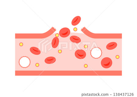 Cross-section of a blood vessel during bleeding 138437126