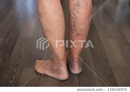Patient showing severe varicose veins on legs Patient showing severe varicose veins on legs 138438978