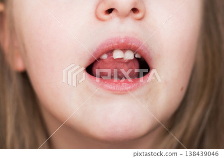 portrait of a little child girl moving her milk front tooth with her tongue in open mouth. portrait of a little child girl moving her milk front tooth with her tongue in open mouth. 138439046