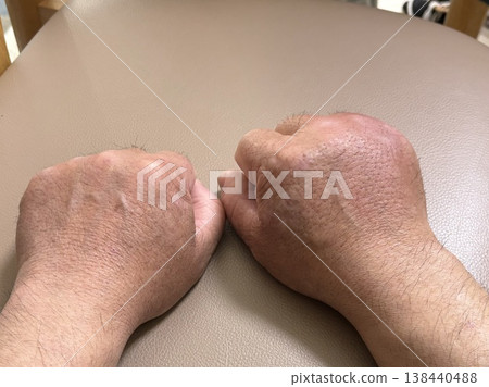 手部腫脹 138440488