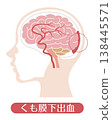 Subarachnoid hemorrhage (medical illustration) 138445571