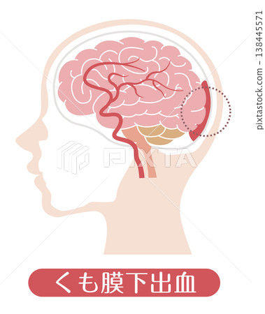 Subarachnoid hemorrhage (medical illustration) Subarachnoid hemorrhage (medical illustration) 138445571