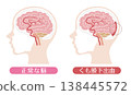 Comparison of a subarachnoid hemorrhage and a normal brain (medical illustration) 138445572