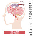 Stroke (Medical Illustration) 138445574