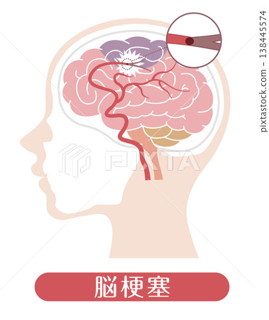 中風（醫學插畫） 138445574