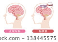 Comparison of a stroke-affected brain and a normal brain (medical illustration) 138445575