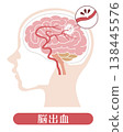Cerebral hemorrhage: Medical illustration 138445576