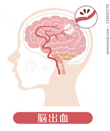 腦出血:醫學插圖 腦出血:醫學插圖 138445576