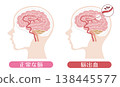 Comparison of a brain with a brain hemorrhage and a normal brain (medical illustration) 138445577