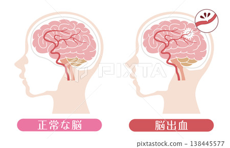 Comparison of a brain with a brain hemorrhage and a normal brain (medical illustration) Comparison of a brain with a brain hemorrhage and a normal brain (medical illustration) 138445577