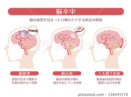 圖示解釋了各種中風類型（腦梗塞、腦出血、蜘蛛網膜下腔出血） 138445578