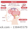 Illustration comparing different types of stroke (cerebral infarction, cerebral hemorrhage, subarachnoid hemorrhage) 138445579