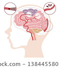Illustration comparing different types of stroke (cerebral infarction, cerebral hemorrhage, subarachnoid hemorrhage) 138445580