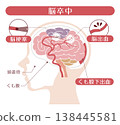Illustration comparing different types of stroke (cerebral infarction, cerebral hemorrhage, subarachnoid hemorrhage) 138445581