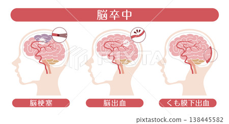 中風類型（腦梗塞、腦出血、蜘蛛網膜下腔出血）－醫學插圖 138445582