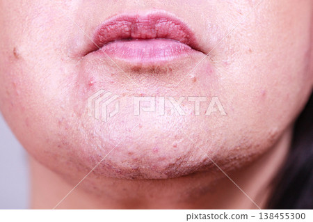 Female face with acne skin problem Female face with acne skin problem 138455300