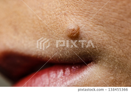 Part of woman face with mole close up Part of woman face with mole close up 138455366