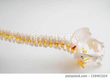 Spinal nerve and bone, Lumbar spine displaced herniated disc fragment, Model for treatment medical in the orthopedic department. Spinal nerve and bone, Lumbar spine displaced herniated disc fragment, Model for treatment medical in the orthopedic department. 138461824